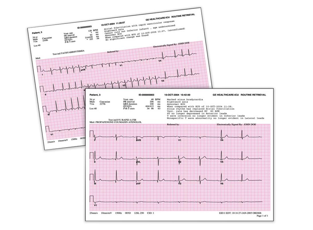 ECG Analysis Programs GE HealthCare (India)