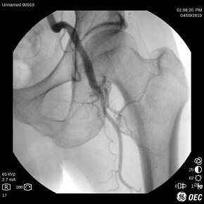 OECOneCFDHip290pixels