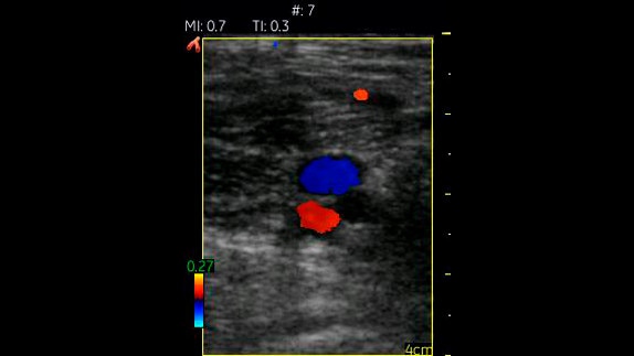 hotspot tours-vscan-popliteal vessels with color flow_jpg