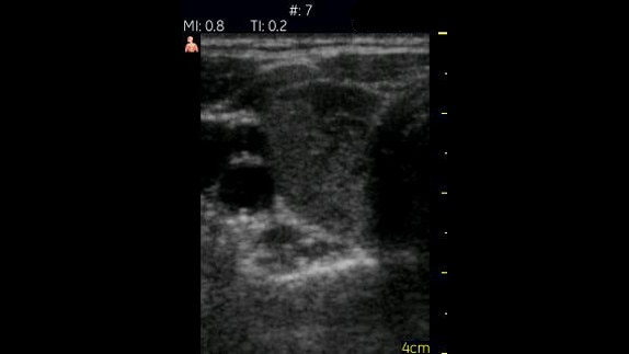 hotspot tours-vscan-thyroid_jpg