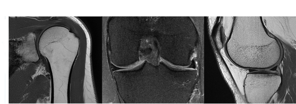 duct-product-categories-magnetic-resonance-imaging-signa artist-shoulderkneecoils_flat.png